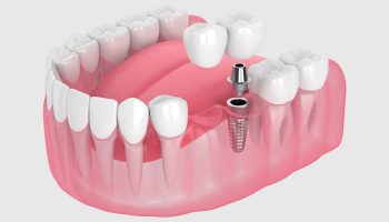 What Is the Procedure of a Dental Implant?