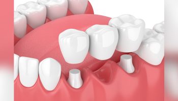 What to Expect When Getting a New Dental Bridge?